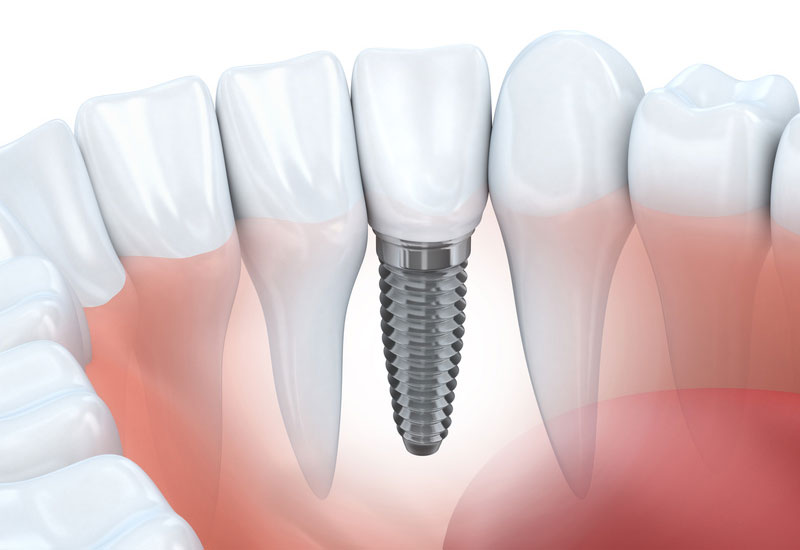 Implantologie Zahnimplantat