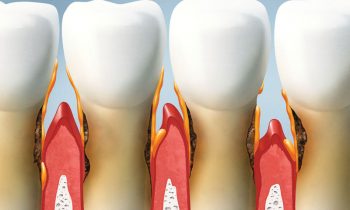 Parodontologie Zahnarztpraxis Moers